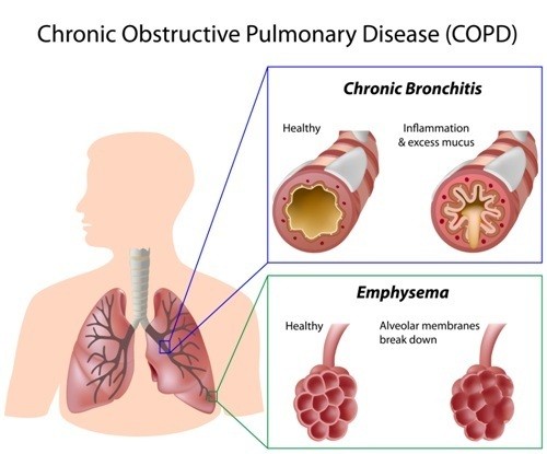 COPD Symptoms and Treatments
